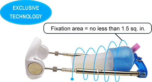 Перейти на страницу вакуумной системы Uvipe GIBRID для улучшения механического экстендера Вакуумная переходная система Uvipe GIBRID для механических экстендеров